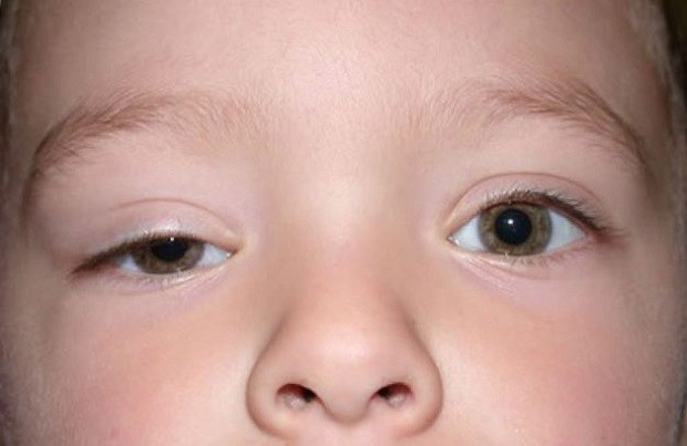 Di truyền là mộ trong những nguyên nhân của mắt cụp