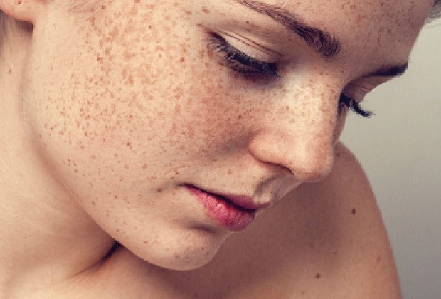 Các loại Nám tàn nhang ảnh hưởng đến da
