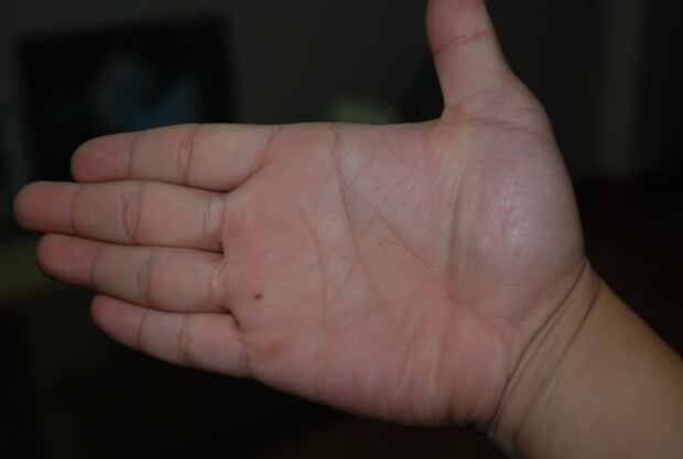 nốt ruồi ở tay trong lòng bàn tay