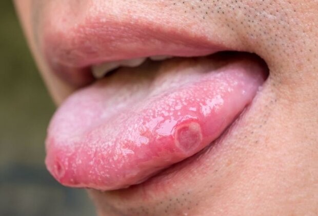 nhiệt miệng cũng gây ra nổi mụn ở lưỡi
