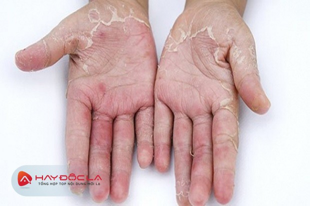 dưỡng ẩm da tay khi tiếp xúc hóa chất