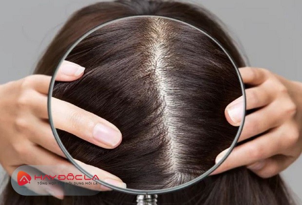 cách để tóc mái không bị hói
